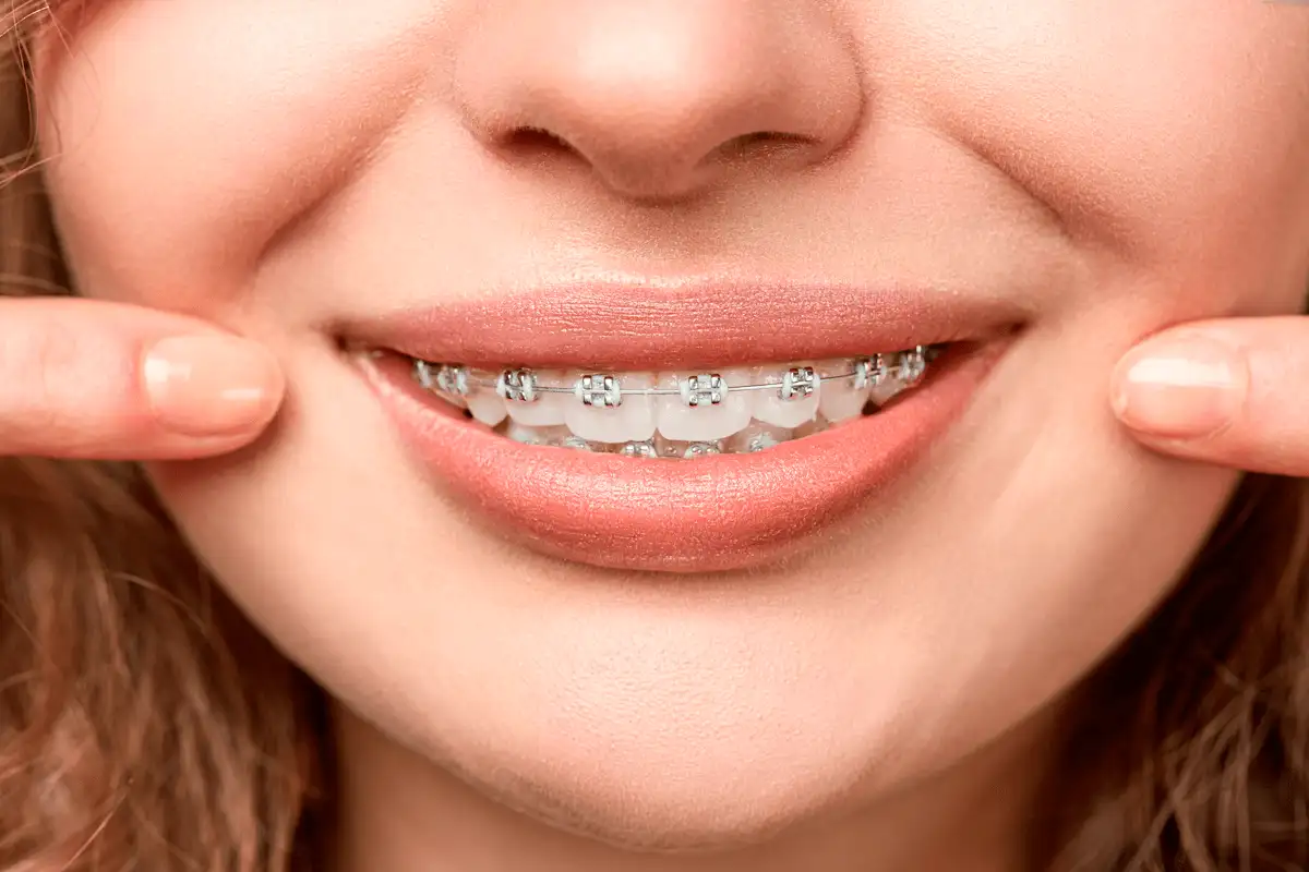 Sonrisa con brackets metálicos